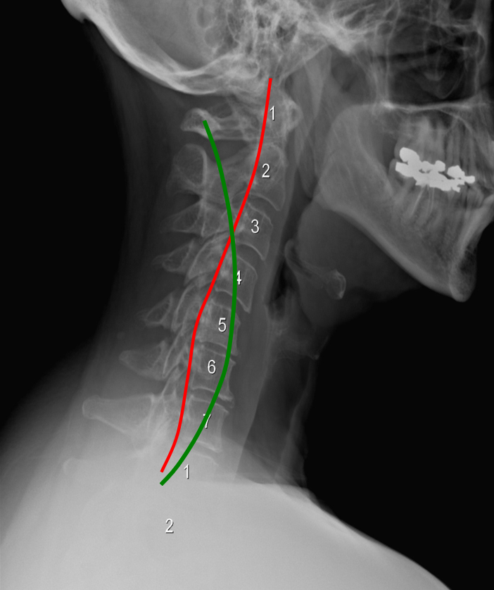 Neck X-ray with numbered cervical vertebrae for chiropractic assessment